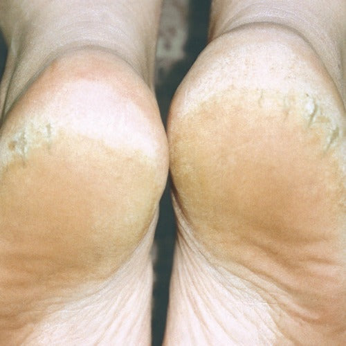 Crack Free Hands & Heels 65gm